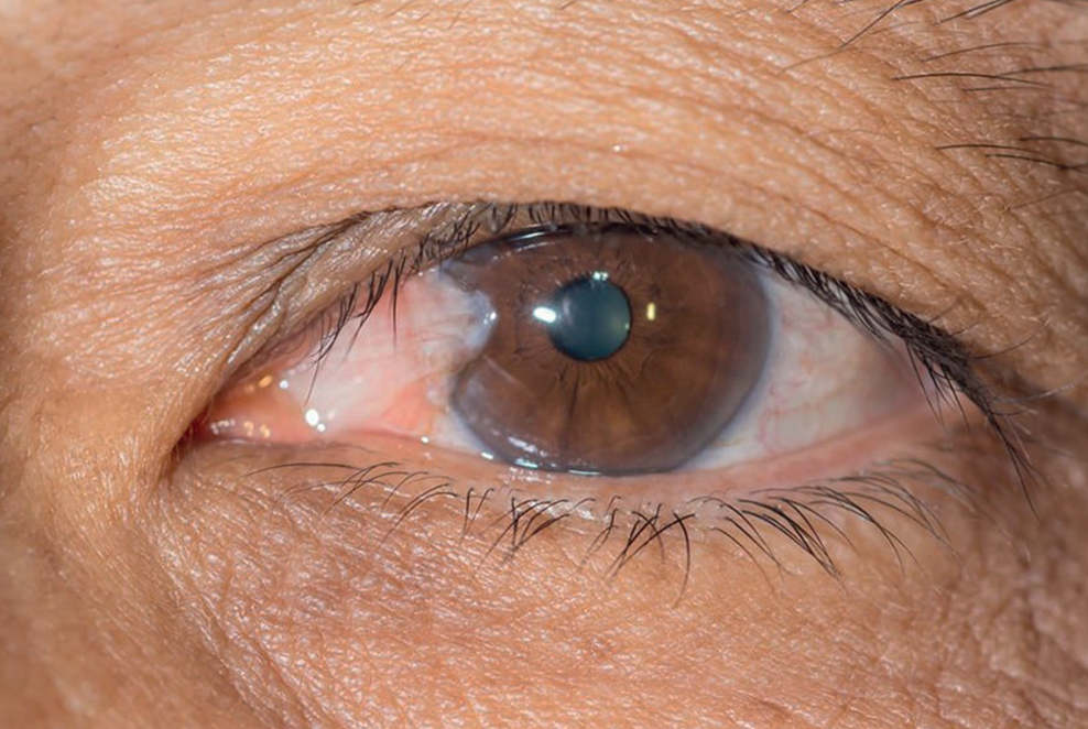 Ordoptic I Dépistage du Glaucome